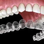 How Invisalign Aligners Correct Bite Irregularities to Alleviate Chronic Headaches