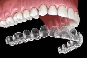 How Invisalign Aligners Correct Bite Irregularities to Alleviate Chronic Headaches