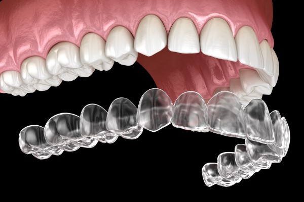 How Invisalign Aligners Correct Bite Irregularities to Alleviate Chronic Headaches
